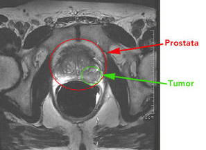 Prostate Cancer - Cancer Center - Deep Learning