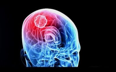 Killing Cancer – New Brain Cancer Treatment Targets Tumors