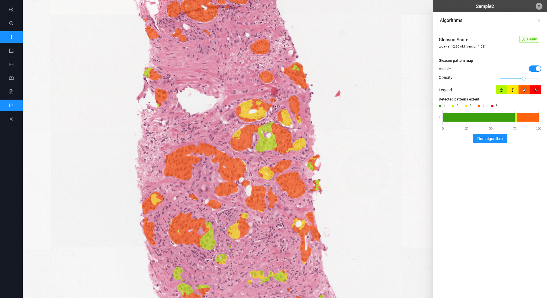 Gleason Score 3 4 Or Other Cancer Center ai AI I Platform In 